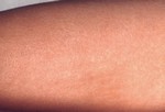 Сыпь при скарлатине выглядит как солнечный ожог и на ощупь как наждачная бумага.
Скарлатина – острый фарингит (воспаление горла) с сыпью. Симптомы: боль в горле, жар, головная боль, боли в животе, увеличенные шейные гланды. Через день-два появляется красная сыпь с шероховатой поверхностью, через 7-14 дней сыпь начинает шелушиться. Скарлатина очень заразна. Почаще мойте руки, это не даст сыпи распространяться дальше по телу. Если вы думаете, что у ребенка именно эта болезнь, немедленно свяжитесь с педиатром. Он пропишет лекарства, которые предотвратят серьезные последствия этой болезни.