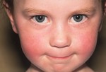 В результате пятой болезни на лице появляется сыпь в виде красноты на щечках.
Инфекционная и обычно средней тяжести болезнь, которая проходит за несколько недель. Симптомы пятой болезни похожи на обычный грипп, сопровождающийся сыпью на лице и теле. Передается воздушно-капельным путем через кашель и чихание. Болезнь особенно заразна за неделю до появления сыпи. В лечение входит – побольше отдыха, побольше воды и болеутоляющие (не принимать аспирин, если у ребенка жар), и следить, чтоб не появились более серьезные симптомы болезни. Если у ребенка пятая болезнь, а вы беременны, то нужно проконсультироваться у доктора.