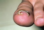 Вросший ноготь чаще всего появляется на большом пальце ноги.
Ноготь, вросший в кожу пальца, может причинять сильную боль, кроме того может появится покраснения, опухоль, и даже инфекция. Подстригание ногтей слишком коротко или не ровно, тесная обувь – все это наносит вред ногтю. При незначительных случаях, опустить ногу в теплую воду, помыть, затем поддеть краешек вросшего ногтя и вытащить его из кожи. При более сложных случаях часть ногтя или весь ноготь удаляется хирургическим путем.