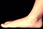 Плоскостопие может наблюдаться как на одной ноге, так и на обоих сразу.
Плоскостопие (pes planus) – это, когда подошва ноги полностью или почти полностью касается земли. Это может унаследовано от родителей, может быть получено вследствие травмы или при определенных болезнях, например, ревматоидный артрит. Симптомы плоскостопия – проблемы с выбором обуви, невозможность долго стоять, так как это вызывает болезненные ощущения. Лечение: упражнения на укрепление стоп, обувь со стельками-супинаторами или ортопедическая обувь.