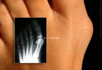 Бурсит или костный нарост у основания большого пальца не заметить нельзя.
Бурсит – это шишка у основания большого пальца. Он является причиной смещения большого пальца в сторону других пальцев. В результате выпячивается кость и у основания пальца нарастает шишка. Бурсит может вызывать сильную боль при давлении или артрите, а также может стать причиной мозолей. В данном случае помогает болеутоляющее, мягкие подкладки для смягчения нароста, специальные вставки в обувь или хирургическое вмешательство. Кроме этого не стоит носить тесную обувь и слишком высоких каблуков.