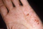 Экзема. Экзема не заразное кожное заболевание, при котором кожа воспаляется, краснеет, шелушится и зудит. Стресс, раздражители (например, мыло), аллергены, климат могут вызвать внезапную вспышку экземы, но они не являются первопричинами экземы. А сами причины болезни не известны. У взрослых экзема появляется чаще всего на локтях, руках и в местах «сгиба», например, на внутренней стороне локтя. Лечение: медпрепараты, уколы, антибиотики, антигистамин или светолечение.