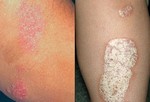 Псориаз. Не заразная сыпь из красных пятен с серебристыми чешуйками. Псориаз обычно поражает кожу головы, локти, колени и поясницу. В некоторых случаях сыпь лечиться, у других остается на всю оставшуюся жизнь. Причина псориаза неизвестна, но воспаление кожи может стать причиной быстрого развития новых клеток кожи. Лечение включает в себя стероидные и ретиноидные кремы, легкая терапия и медпрепараты.