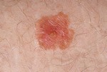 Болезнь Боуэна.
Болезнь Боуэна также называют плоскоклеточным раком «in situ». Это вид рака кожи, который распространяется по поверхности кожи. «Агрессивный» плоскоклеточный рак может развиваться внутри и распространятся внутри организма. Болезнь Боуэна выглядит как шелушащиеся, красные пятна, которые могут покрываться коркой. Часто эти пятна путают с обычной сыпью, экземой, грибком или псориазом.
