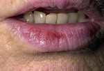 Актинический хейлит («Губа фермера»).
Как и старческий кератоз, актинический хейлит – это первый признак рака кожи, который появляется на нижней губе. Он проявляется в виде чешуйчатых пятен или постоянной сухости и потрескивании губ. Более редкие симптомы – опухание, размывание четкой границы губ, заметная выпуклость губ. При отсутствии лечения актинический хейлит может развиться в плоскоклеточный рак.
