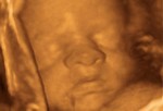 Развитие эмбриона на 28 неделе.
Вес ребенка чуть больше 1 кг. На этом этапе беременности ребенок часто меняет положение. Кроме того, в этот период могут начаться преждевременные роды или выкидыш. Поэтому поинтересуйтесь у своего врача о настораживающих симптомах преждевременных родов. Запишитесь на курсы для будущих мам. На курсах вы узнаете много полезного о самих родах, а также как нужно заботиться о новорожденном.