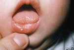 Грибковые заболевания замыкают тройку самых распространенных проблем с детской кожей

Грибковые заболевания у детей
Они, как правило, имеют место быть после курса лечения антибиотиками и появляются в разных местах. Грибок может возникнуть на губах и языке, при этом с виду он похож на сухое молоко, или же на маленькие красные точки (если речь идет о гениталиях). Обратитесь к педиатру: обычно грибки лечат специальными жидкими средствами, параллельно используя противогрибковый крем (опять-таки, если речь идет о половых органах).
