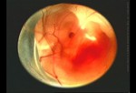 Эмбрион на восьмой неделе беременности.
Развитие эмбриона.
После имплантации некоторые клетки преобразуются в плаценту, а другие – в эмбрион. Через 3 недели после овуляции начинают развиваться мозг ребенка, спинной мозг, сердце и другие органы. Сердце начинает биться уже на пятой неделе. На седьмой неделе появляется пуповина. На восьмой неделе эмбрион достигает размера около 1,3 см в длину и с этого момента начинает интенсивно расти. Рождение ребенка происходит приблизительно на 40-й неделе.